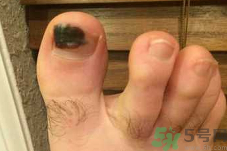 腳趾甲變黑是什么原因？腳趾甲變黑是怎么回事？