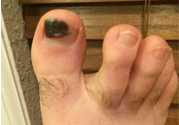 腳趾甲變黑是什么原因？腳趾甲變黑是怎么回事？