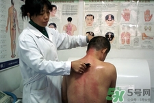 背部刮痧能祛痘嗎？背部刮痧需要注意什么？