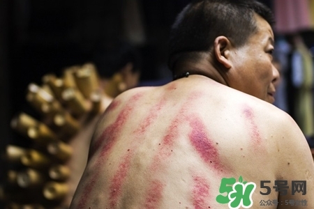 背部刮痧后能拔火罐嗎？背部刮痧后拔火罐有什么好處？