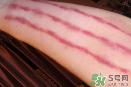 揪痧和刮痧哪個效果比較好？揪痧和刮痧的區(qū)別？