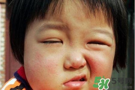 拔牙會導(dǎo)致面癱嗎?？拔牙為什么會導(dǎo)致面癱？