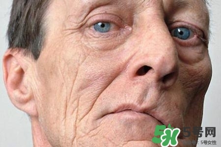 老年人為什么容易得面癱？老年人面癱原因有哪些？