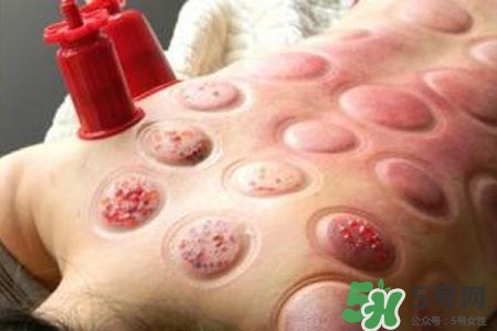 拔罐放血對身體好嗎？拔罐放血有什么好處？