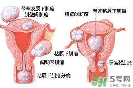 子宮小會(huì)影響生育嗎？子宮小會(huì)導(dǎo)致不孕嗎？