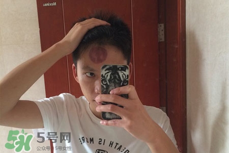 拔罐后皮膚癢能撓嗎？拔罐后身上癢切忌抓撓