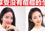 伊詩蘭頓祛痘怎么樣？伊詩蘭頓祛痘膏有用嗎？