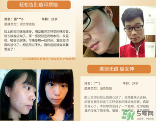 芷軒堂祛痘有效果嗎？芷軒堂祛痘印效果怎么樣？