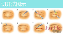 定點(diǎn)雙眼皮怎么做？定點(diǎn)雙眼皮需要拆線嗎？