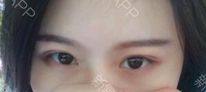 定點(diǎn)雙眼皮能保持多久？定點(diǎn)雙眼皮是永久的嗎？
