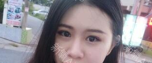 定點(diǎn)雙眼皮能保持多久？定點(diǎn)雙眼皮是永久的嗎？