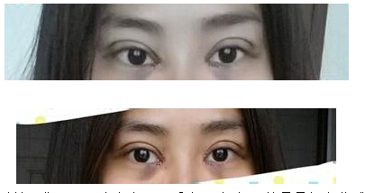 定點(diǎn)雙眼皮怎么做？定點(diǎn)雙眼皮需要拆線嗎？
