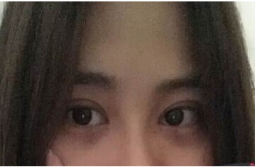 定點(diǎn)雙眼皮怎么做？定點(diǎn)雙眼皮需要拆線嗎？