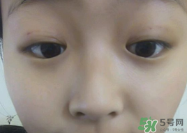 埋線雙眼皮需要拆線嗎？埋線雙眼皮怎么拆線