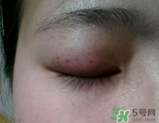 埋線雙眼皮需要拆線嗎？埋線雙眼皮怎么拆線