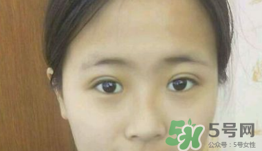 埋線雙眼皮需要拆線嗎？埋線雙眼皮怎么拆線