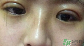 埋線雙眼皮需要拆線嗎？埋線雙眼皮怎么拆線