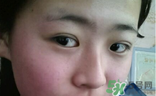埋線雙眼皮需要拆線嗎？埋線雙眼皮怎么拆線