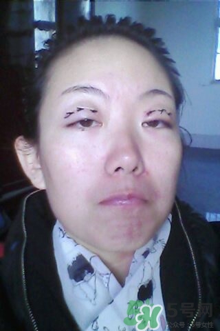 什么是定點(diǎn)雙眼皮？定點(diǎn)雙眼皮多少錢？