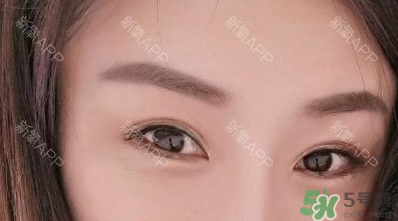 埋線雙眼皮能保持多久？埋線雙眼皮是永久嗎