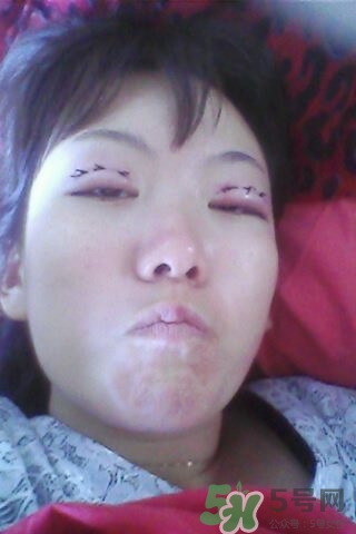 什么是定點(diǎn)雙眼皮？定點(diǎn)雙眼皮多少錢？
