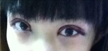 韓式三點(diǎn)雙眼皮是永久嗎？三點(diǎn)雙眼皮能保持多久？