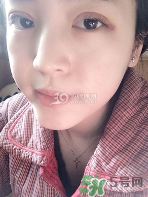 什么是定點(diǎn)雙眼皮？定點(diǎn)雙眼皮多少錢？
