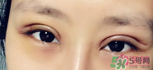切開(kāi)雙眼皮多久消腫？切開(kāi)雙眼皮多久恢復(fù)？