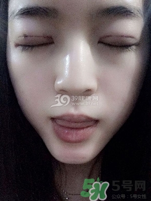 什么是定點(diǎn)雙眼皮？定點(diǎn)雙眼皮多少錢？
