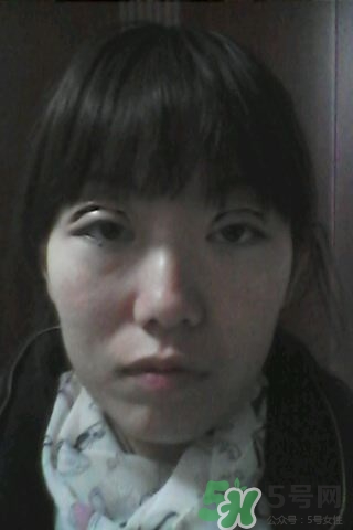 什么是定點(diǎn)雙眼皮？定點(diǎn)雙眼皮多少錢？