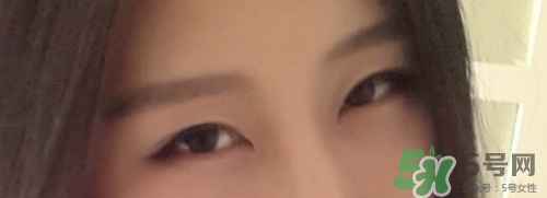 切開(kāi)雙眼皮多久消腫？切開(kāi)雙眼皮多久恢復(fù)？