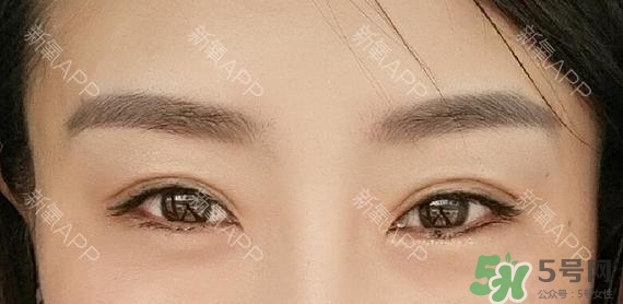 埋線雙眼皮能保持多久？埋線雙眼皮是永久嗎