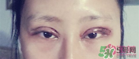切開(kāi)雙眼皮多久消腫？切開(kāi)雙眼皮多久恢復(fù)？