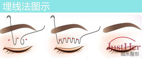 定點(diǎn)雙眼皮怎么做？定點(diǎn)雙眼皮需要拆線嗎？