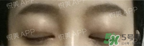 埋線雙眼皮多久恢復(fù)自然？埋線雙眼皮多久能恢復(fù)