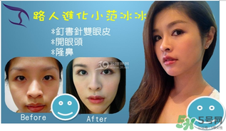 重瞼術(shù)是什么？重瞼術(shù)是永久的嗎？