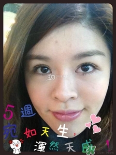 重瞼術(shù)是什么？重瞼術(shù)是永久的嗎？