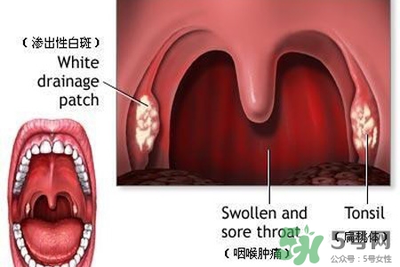 霧霾天喉嚨痛怎么辦？霧霾天嗓子疼怎么辦？