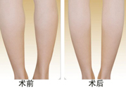 小腿吸脂多久見效？小腿吸脂后多久能看見效果？
