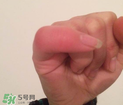 小拇指凍腫了怎么辦？為什么小拇指容易凍？
