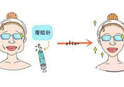 咬肌會(huì)改變臉型嗎？切除咬肌會(huì)改變臉型嗎？