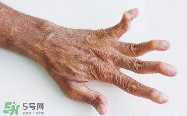 類風濕性關(guān)節(jié)炎可以治愈嗎?類風濕性關(guān)節(jié)炎能根治嗎?