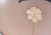 妊娠線每個(gè)孕婦都有嗎？妊娠線出現(xiàn)的時(shí)間
