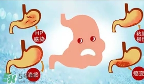 神經(jīng)性胃痙攣是什么？神經(jīng)性胃痙攣是什么原因？