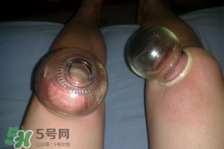 小腿能拔罐嗎？在小腿上拔火罐有什么作用？