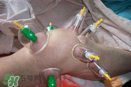 小腿能拔罐嗎？在小腿上拔火罐有什么作用？