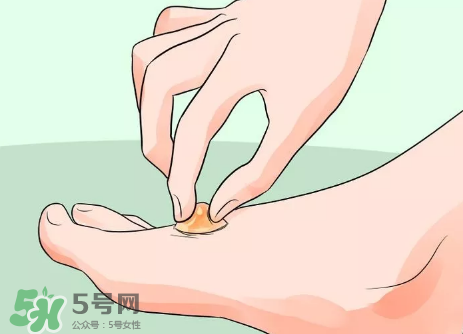 水泡怎么處理？水泡要不要刺破？