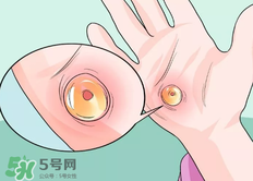 水泡怎么處理？水泡要不要刺破？