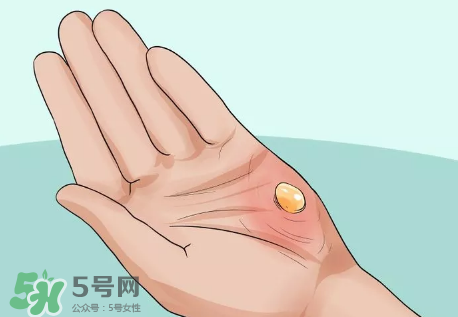 水泡怎么處理？水泡要不要刺破？