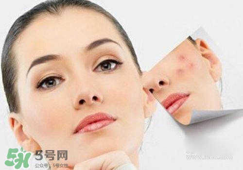 封閉性粉刺會自己消失嗎？封閉性粉刺好了會留疤嗎？